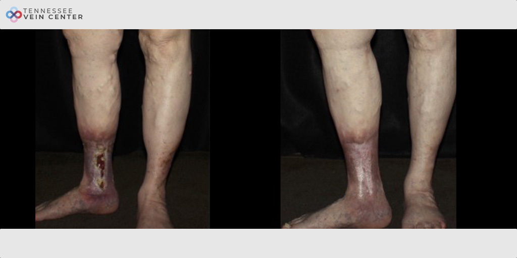 Varicose Veins 1038