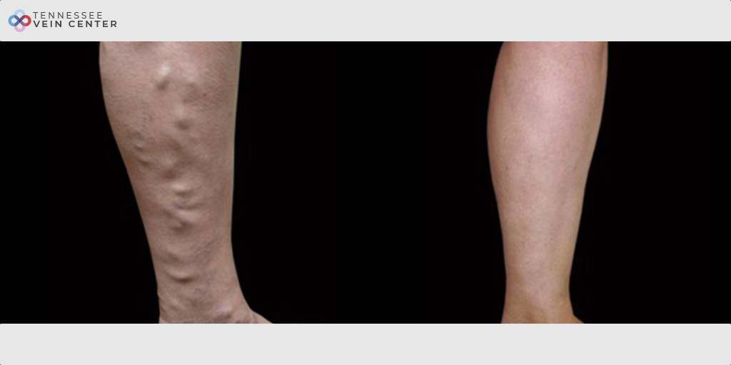 Varicose Veins 1057