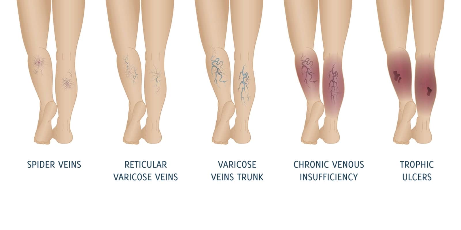 Why Treat Veins Tennessee Vein Center