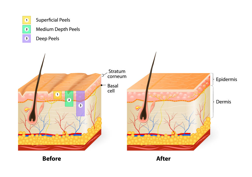 Corrective Chemical Skin Peels