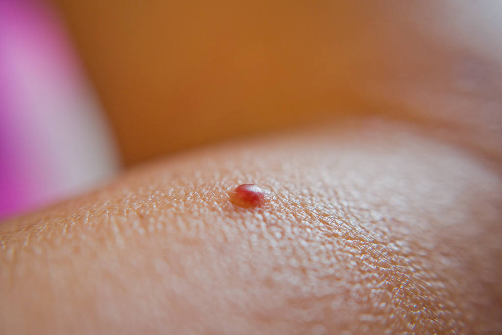 Cherry Angiomas