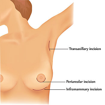 Bay Area Breast Augmentation