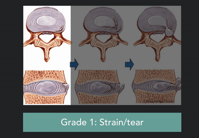 Not all disc injuries are equal, they typically have three grades of severity. Symptoms don't always directly correlate to injury severity