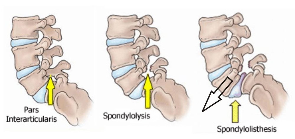 Extension overload often results in boney stress to the facet joints of the lumbar spine