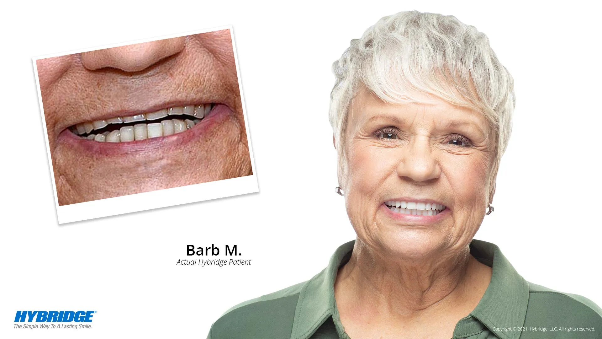 Hybridge Dental Implant Bridge Harrisonburg, VA