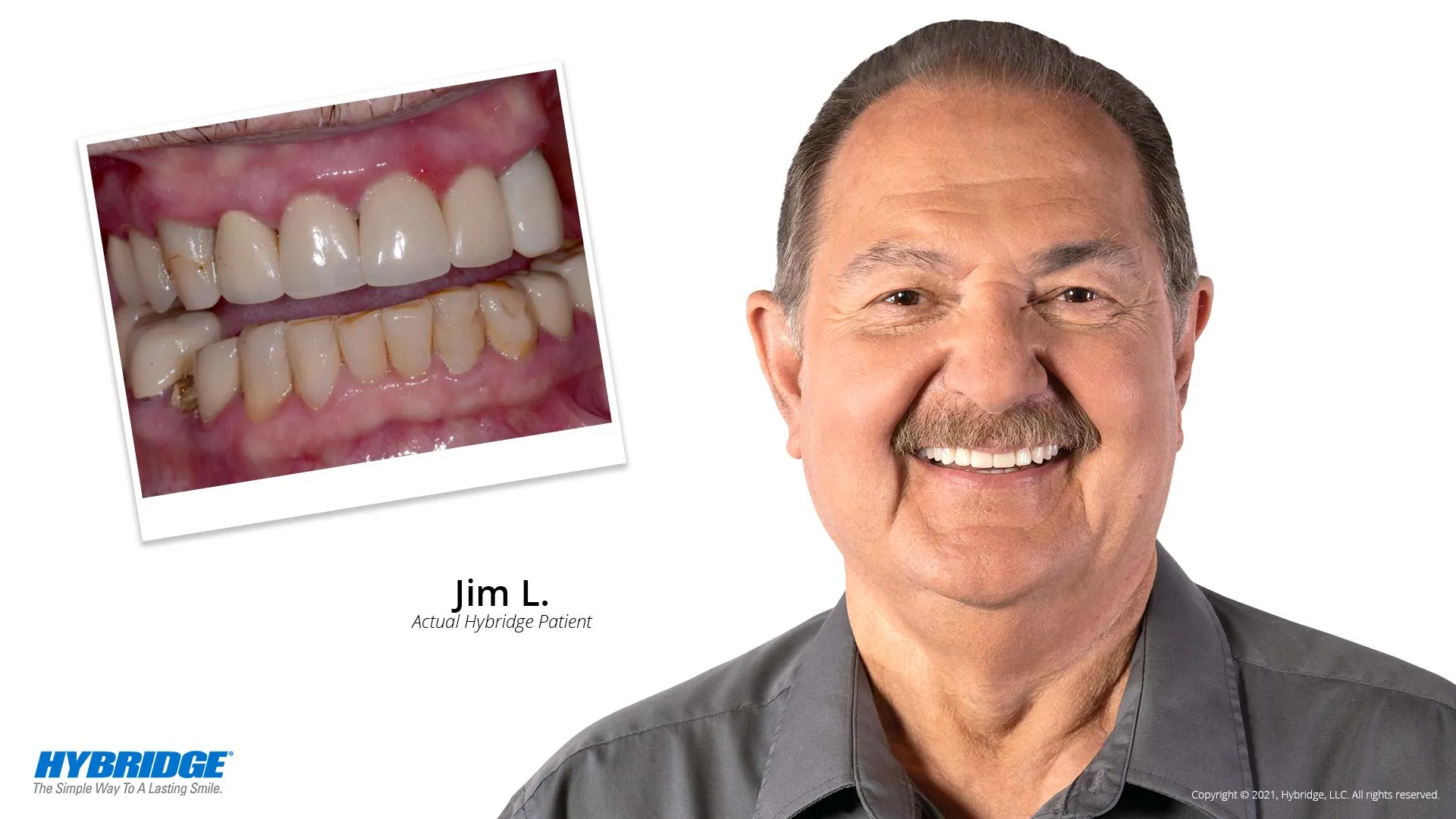 Hybridge Dental Implant Bridge Harrisonburg, VA