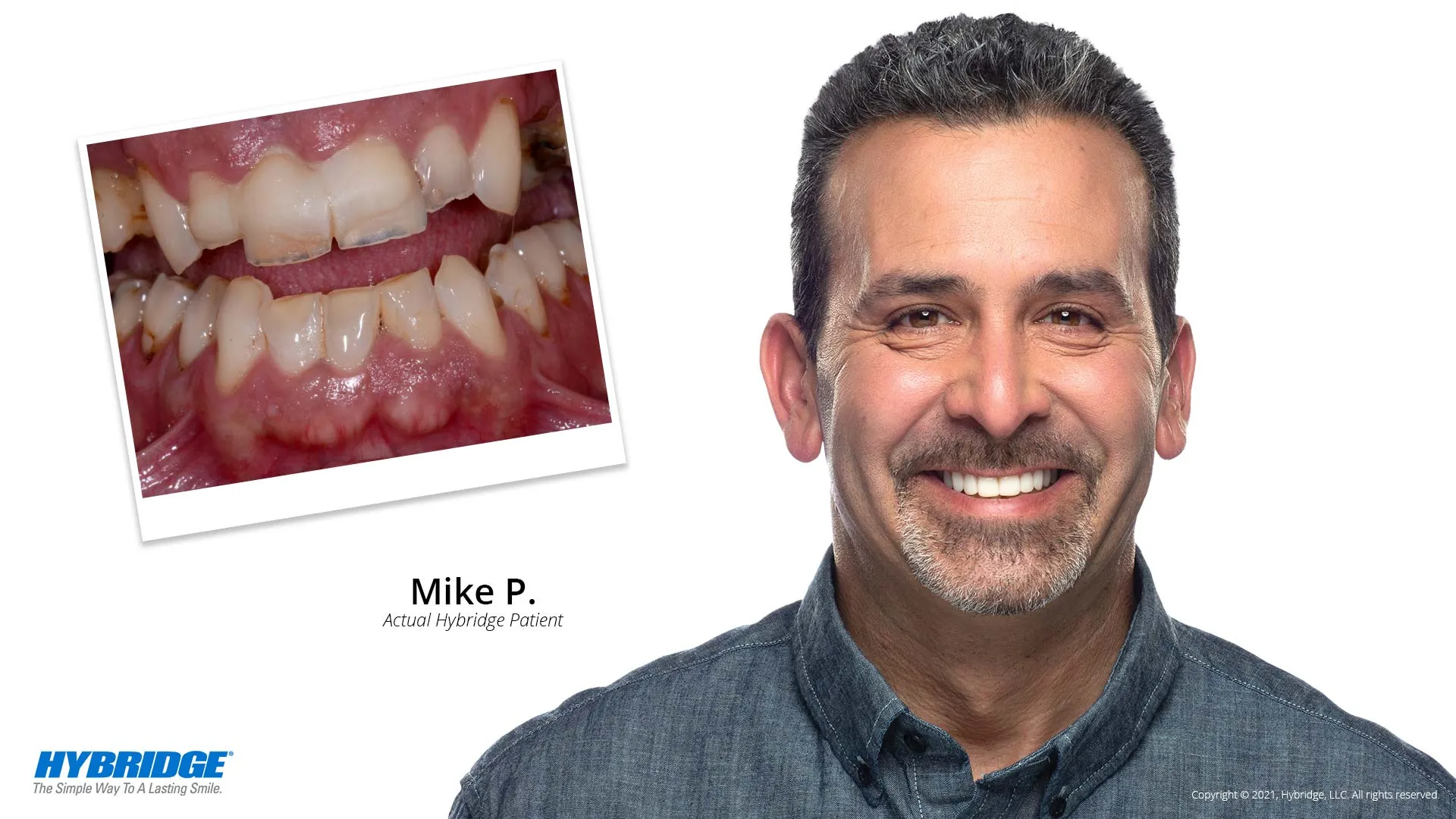 Hybridge Dental Implant Bridge Harrisonburg, VA