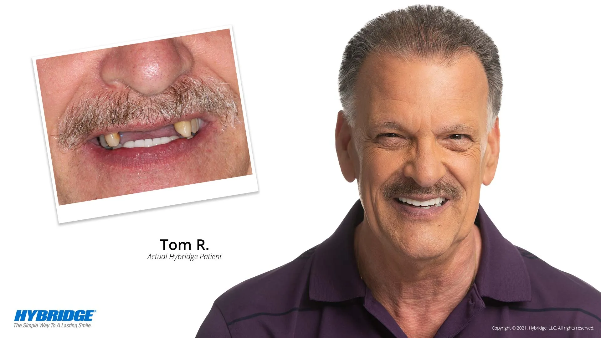 Hybridge Dental Implant Bridge Harrisonburg, VA