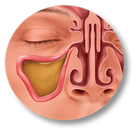 sinus infection surgery