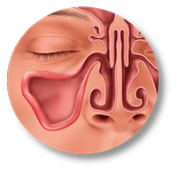 sinus balloon surgery