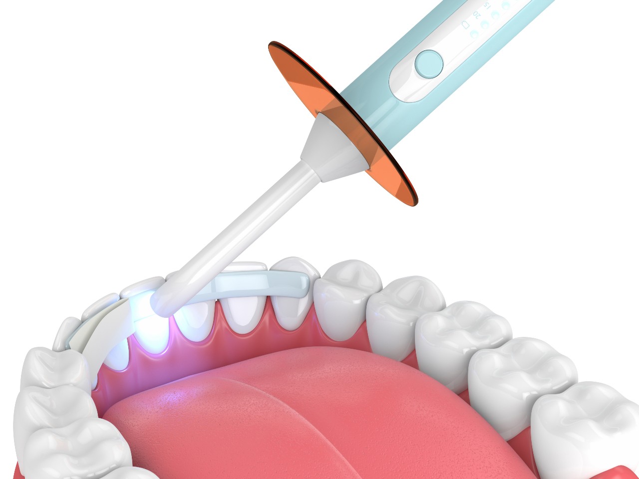 Invisalign vs Braces