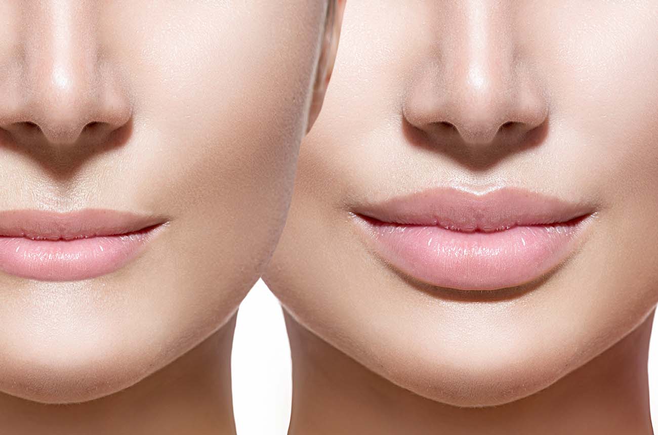 Lip Enhancement