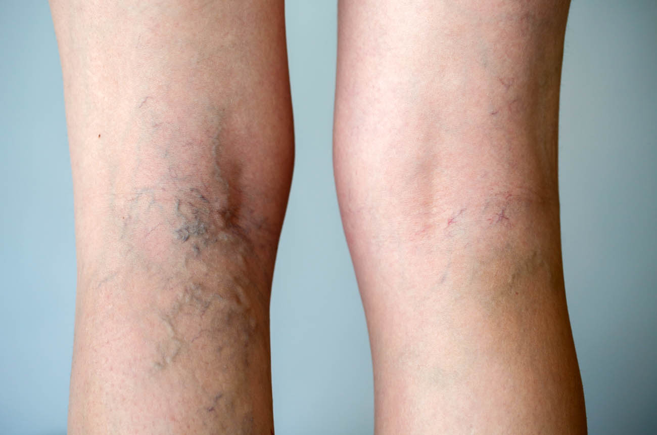 Vein Removal Treatment Before & After