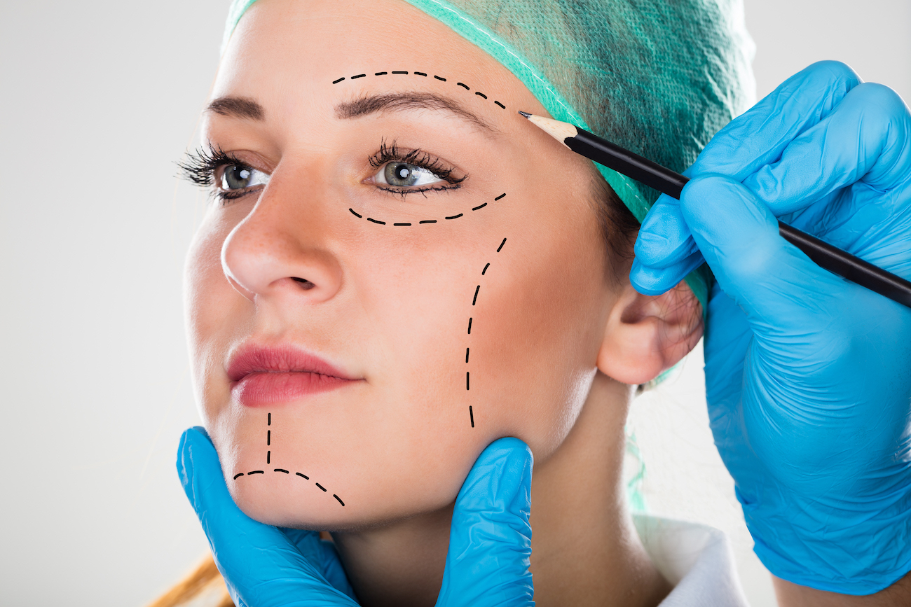 surgeon drawing lines on woman's face before facelift
