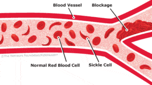 Sickle Cell © The Nemours Foundation