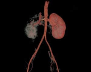 medical malpractice kidney