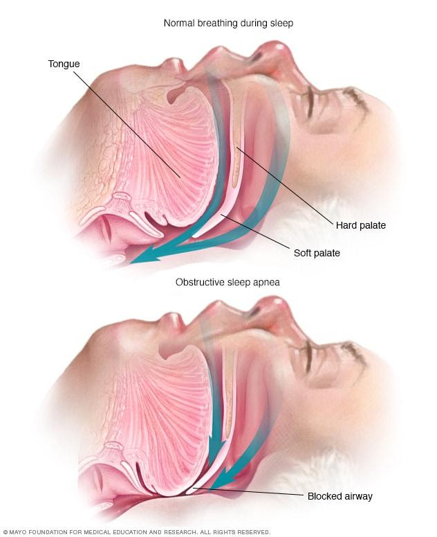 Obstructive sleep apnea - Symptoms and causes - Mayo Clinic