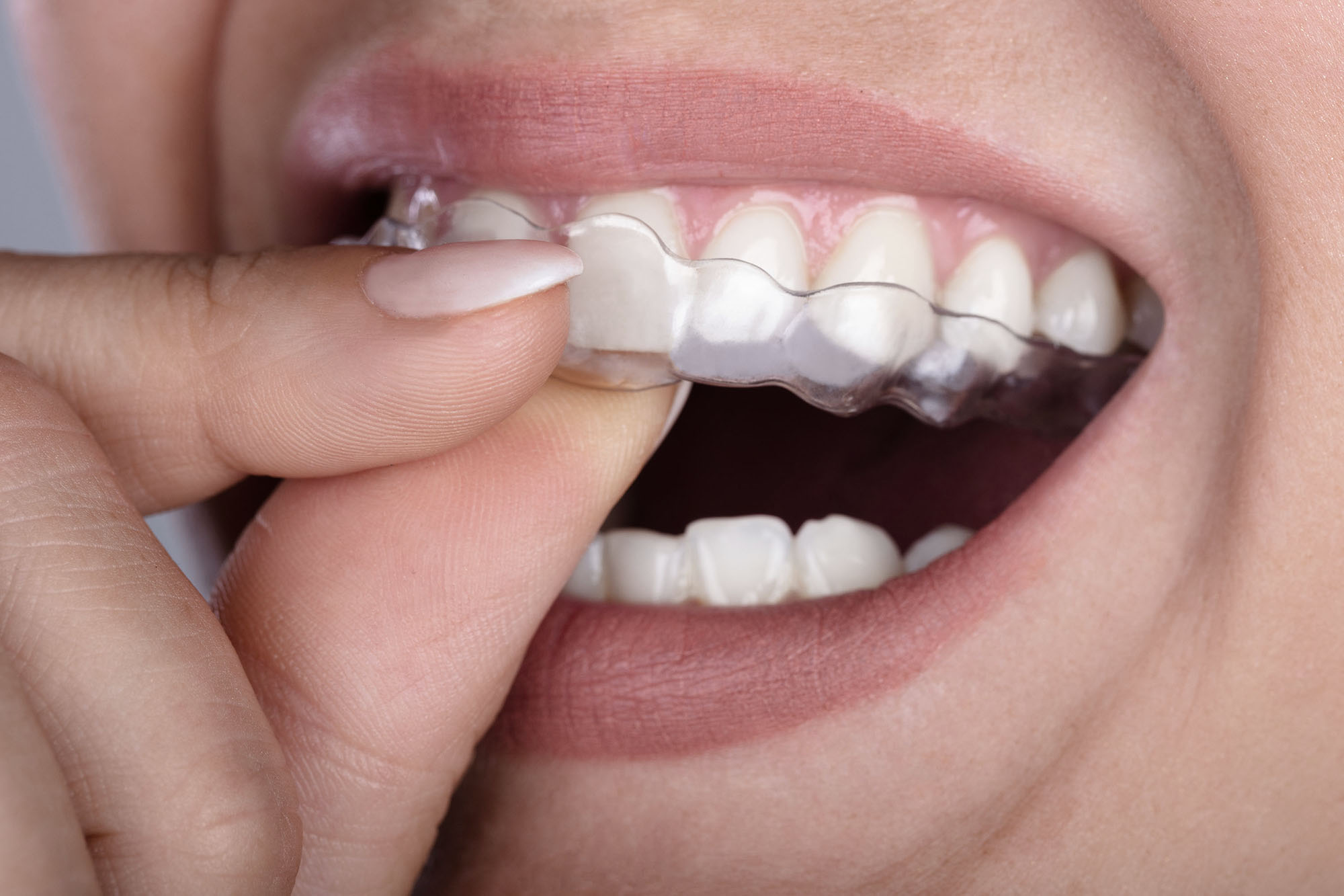 Straightening Aligners Edge Dental Care in Edgware