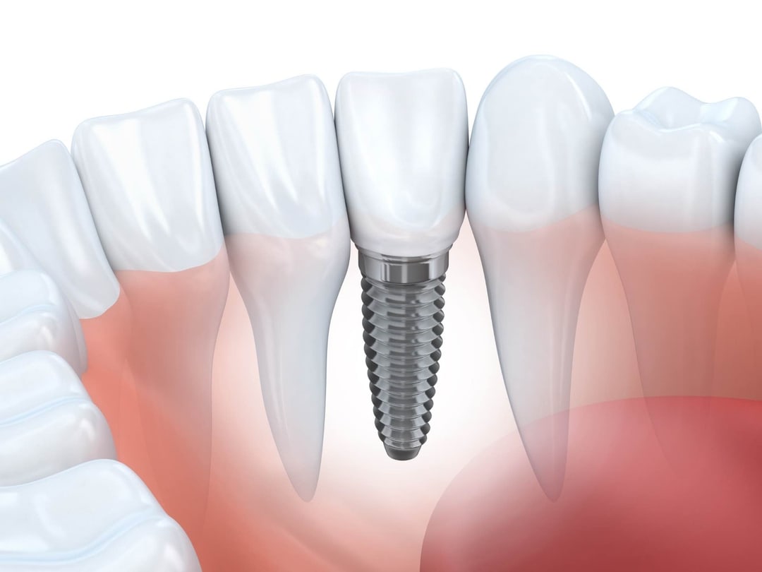 Venice Implant Dentistry & Laser