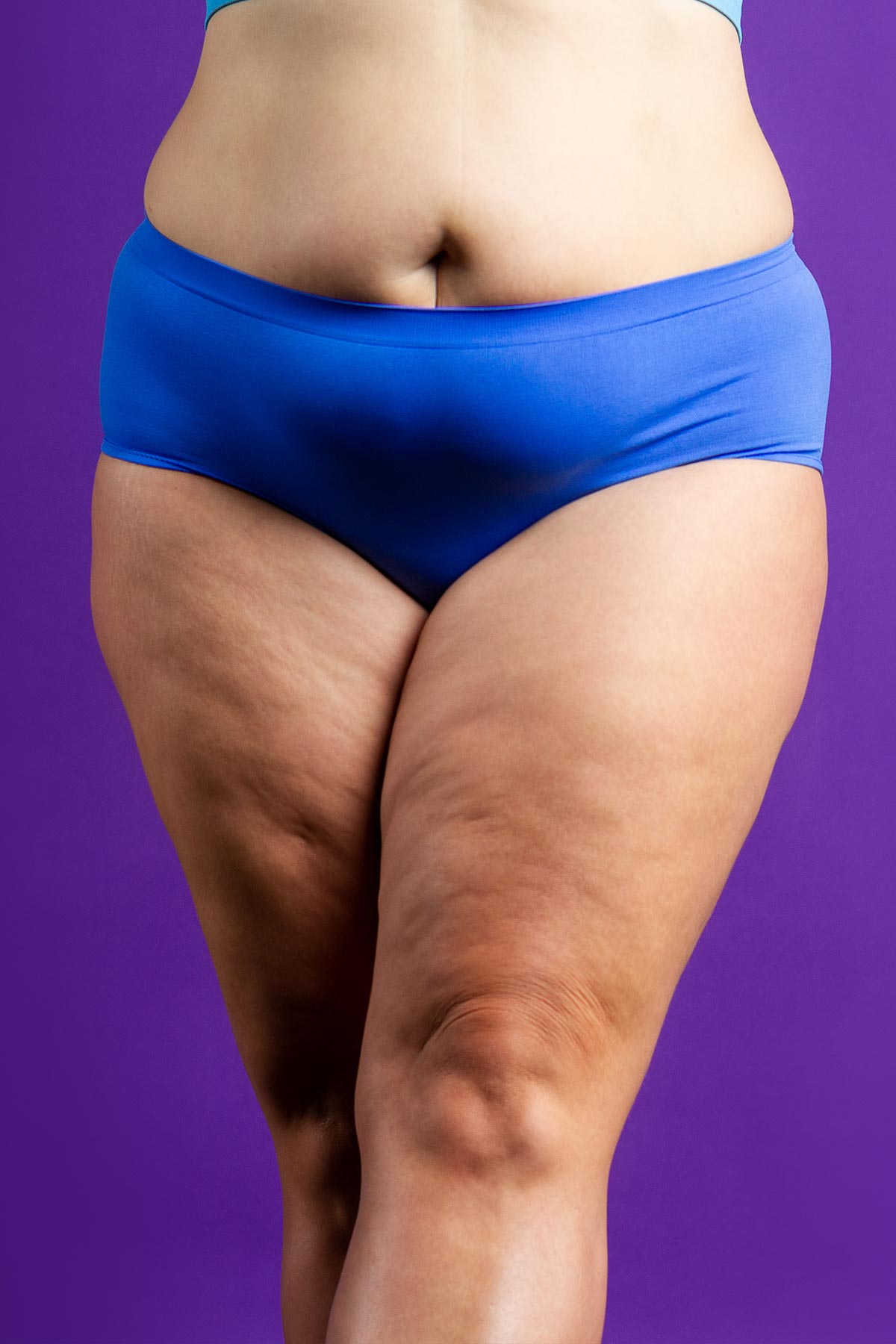 Thigh Lift Mississauga & Oakville