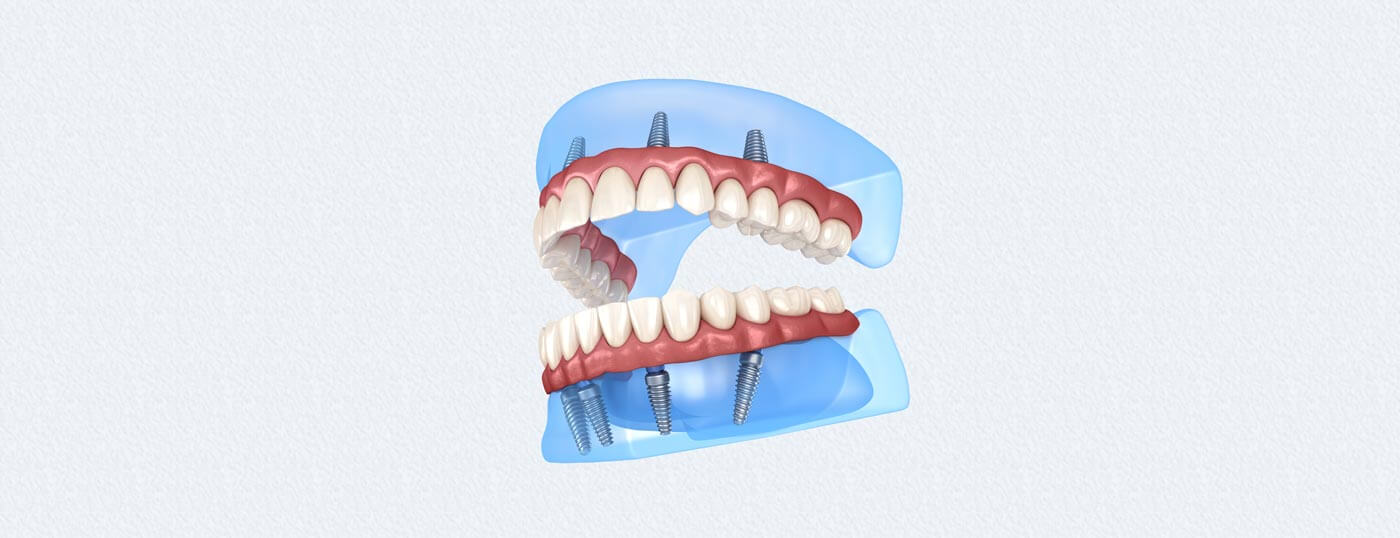 Dentures In Reno Smile Design Implant Dentistry