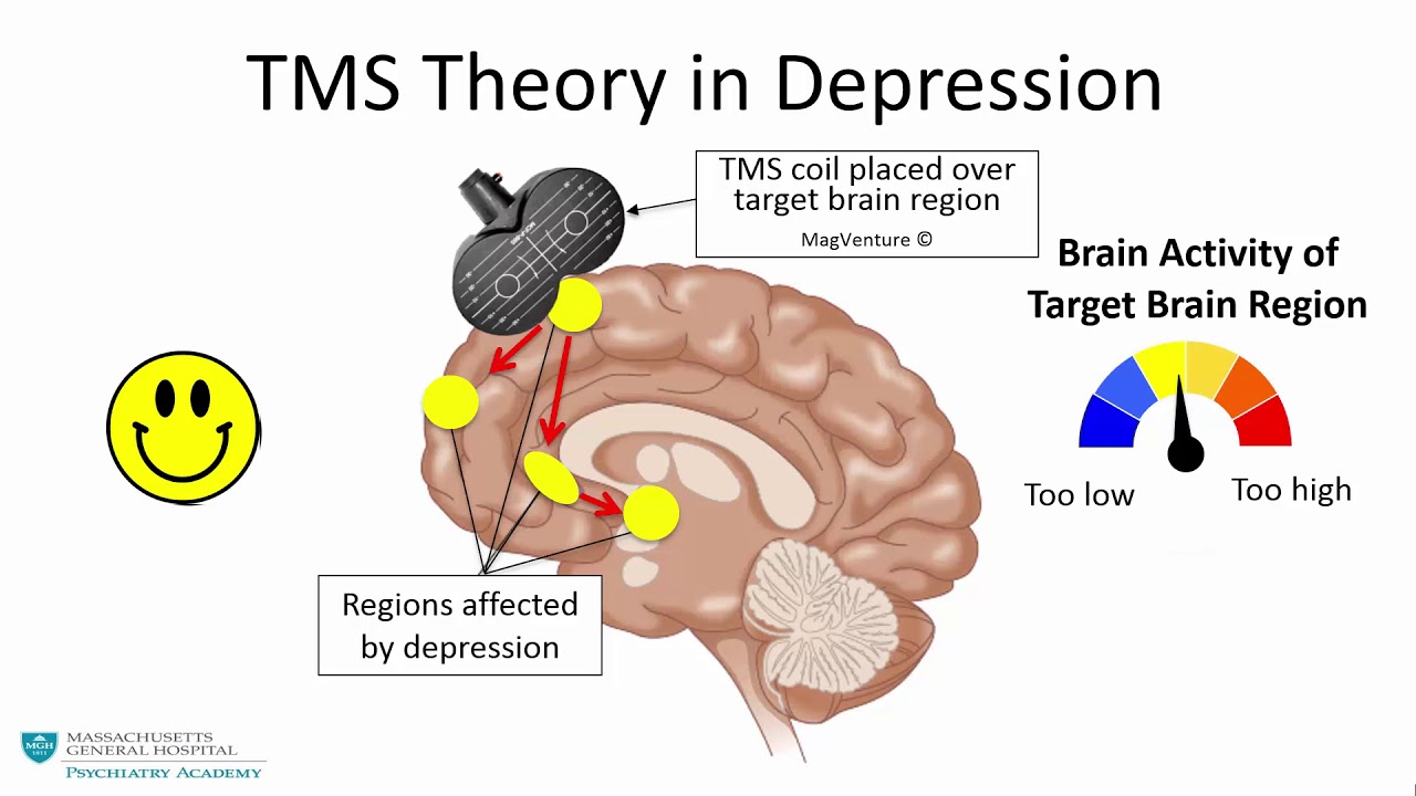 Animated representation of how TMS works to treat depression