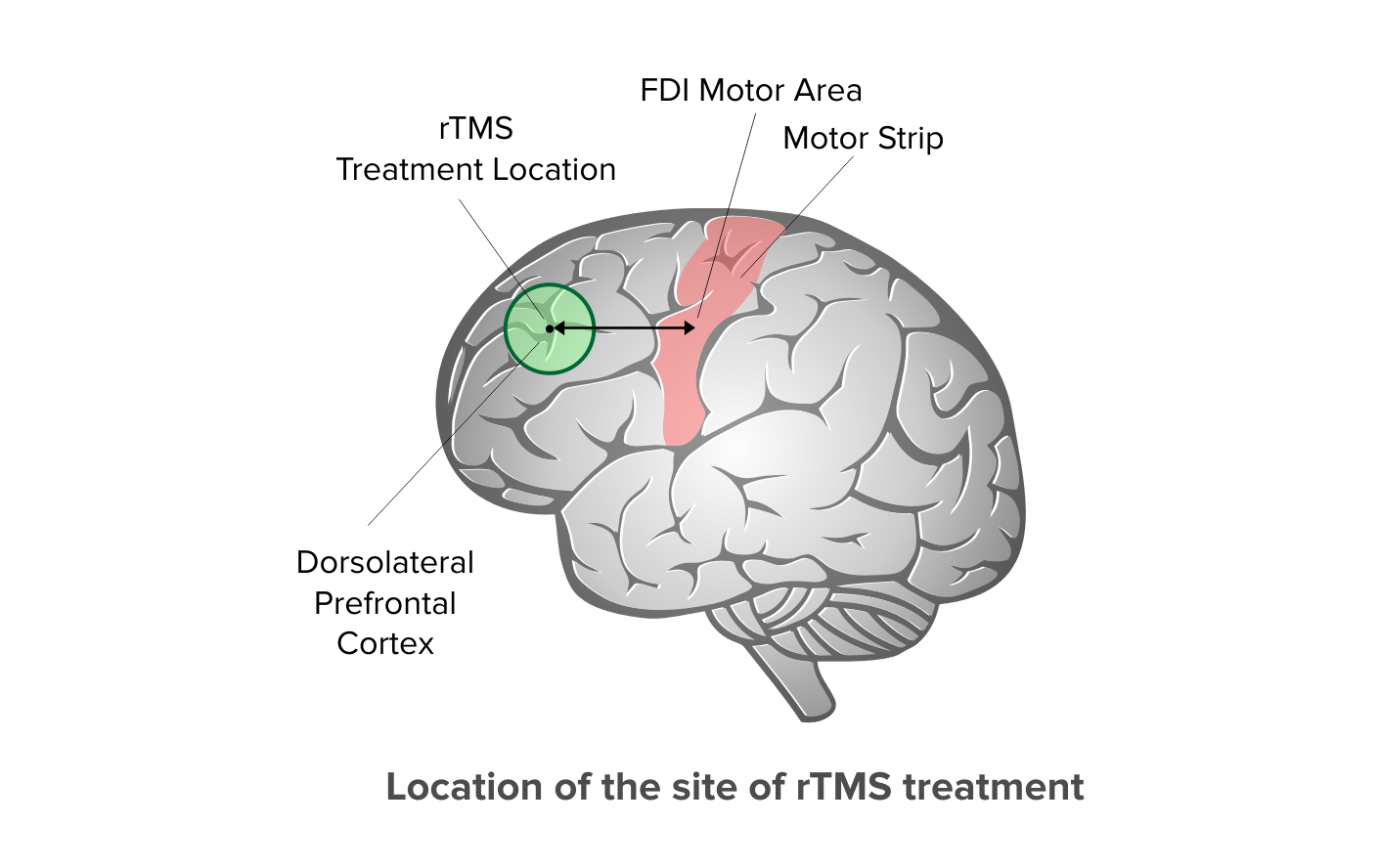 Diagram showing how TMS placement is determined.