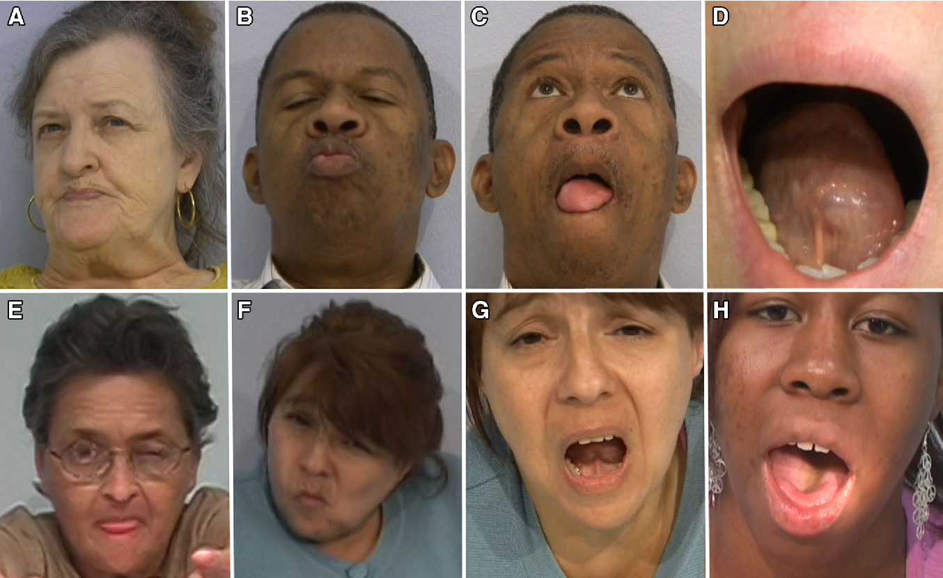 Patients exhibit symptoms of tardive dyskinesia