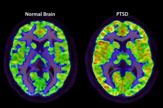 normal brain vs ptsd brain