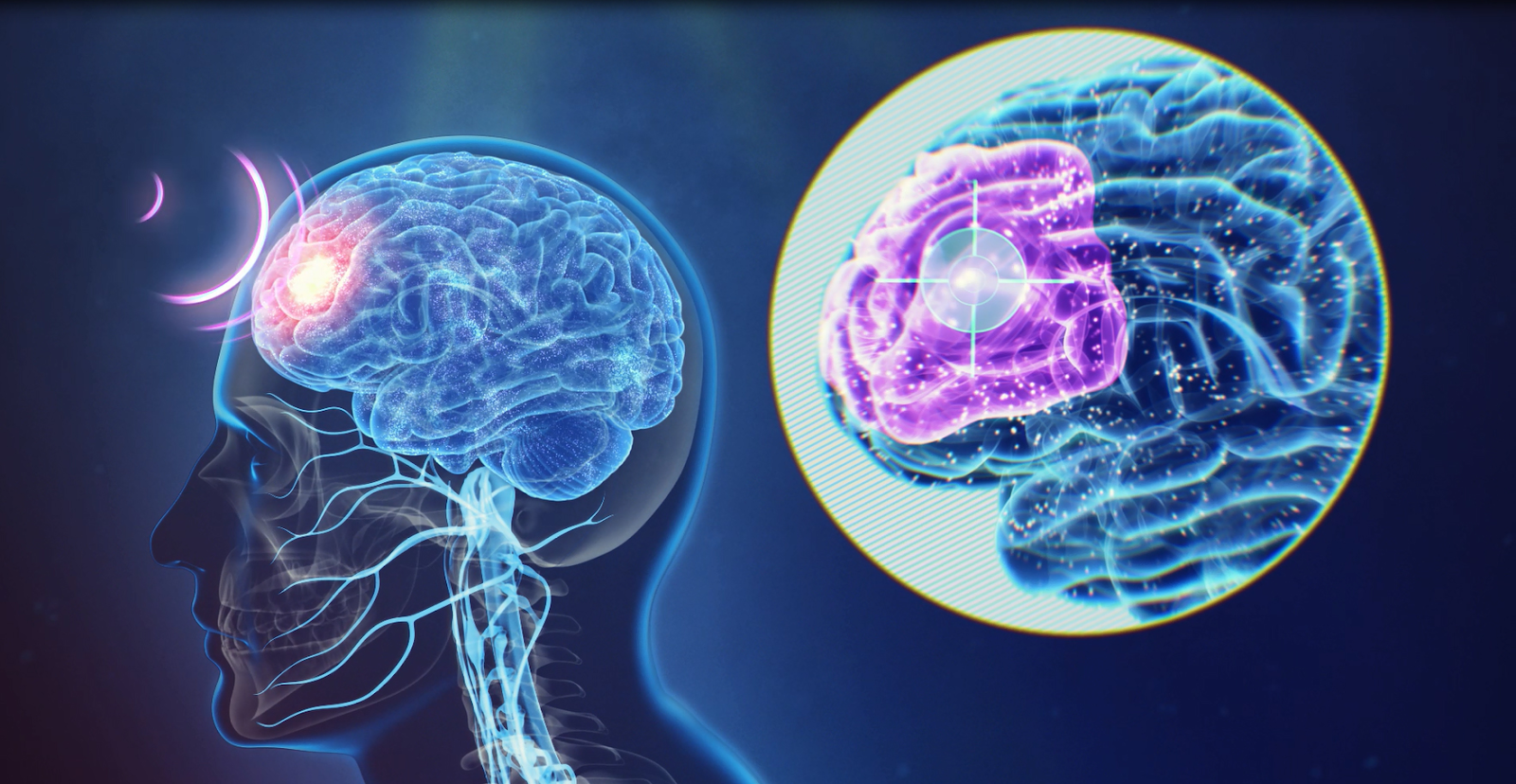 A computer generated image that shows the brain through the skull. Purple lines are moving toward a section of the brain that is highlighted in red. A second, zoomed in image of the brain shows the area in purple.