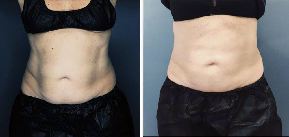 Coolsculpting image of woman's waist before and after
