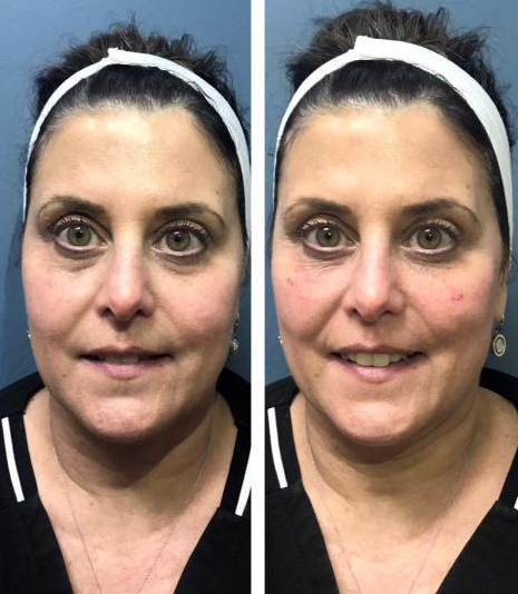 before/after of Tear Trough Filler Using Restylane Lyft and Restylane L.
