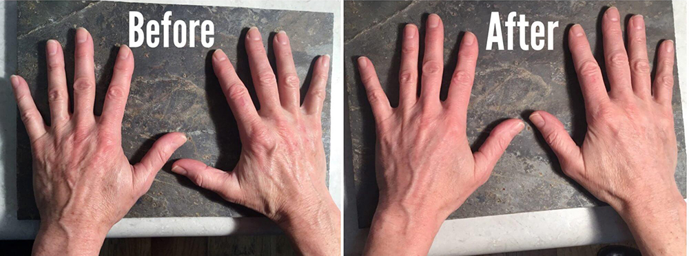 Before and After of hands with fillers used