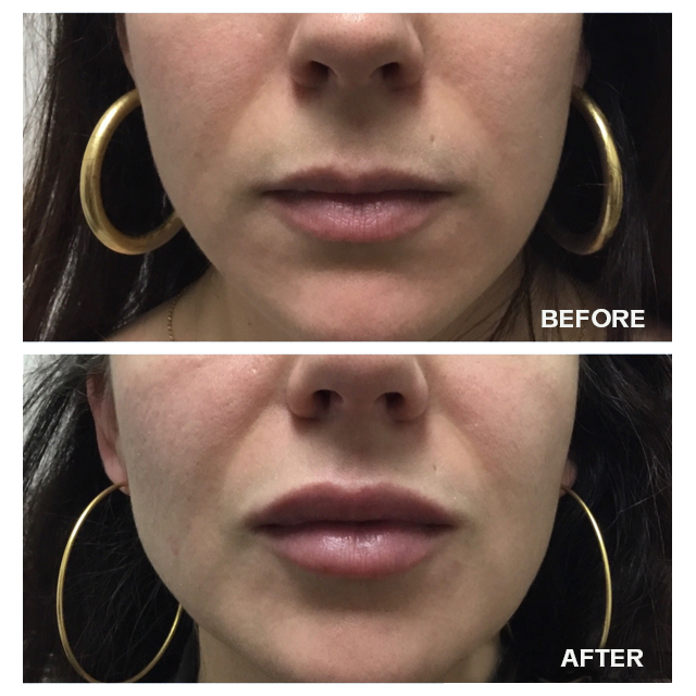 Before and after of lips after fillers