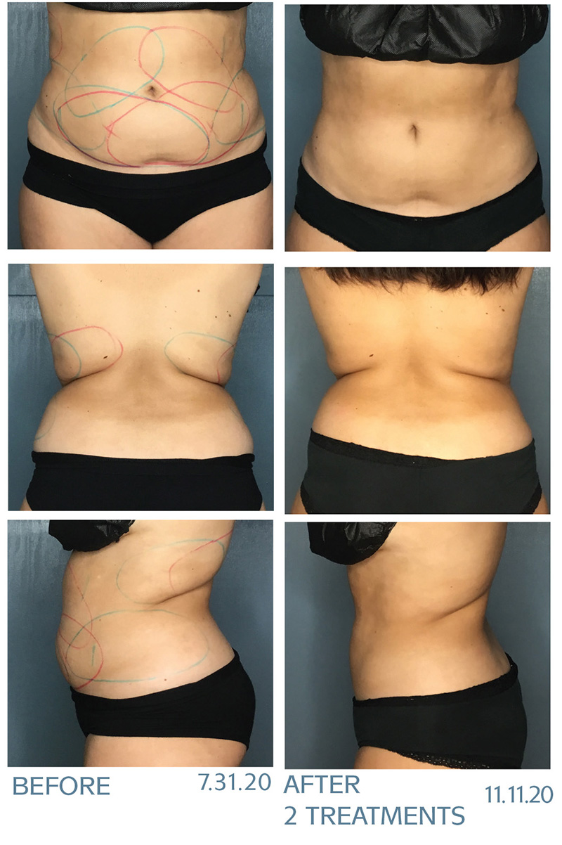 Front, back, side of client before and 2 months after CoolSculpting treatments