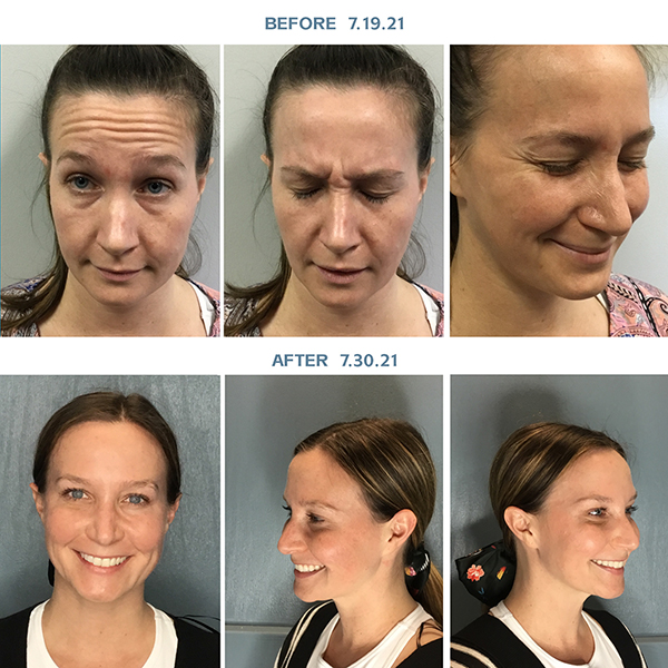 Before and After of female when Botox and Juvederm was used