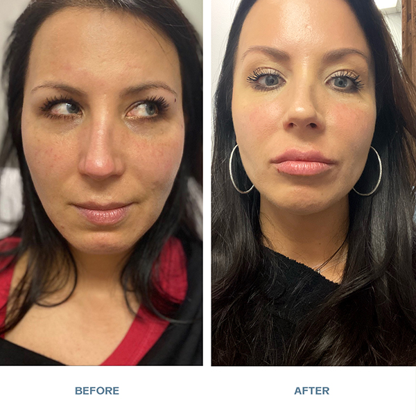 Juvéderm® Vollure® XC lips and nasolabial folds before and after