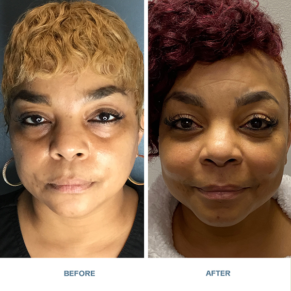 Juvéderm® Voluma® XC and Juvéderm® Vollure® XC in cheeks before and after