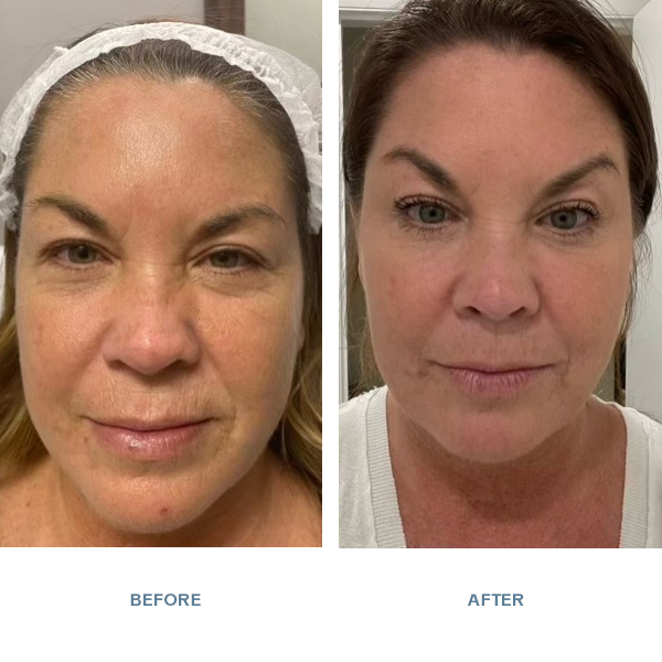 Juvéderm® Voluma® XC and Juvéderm® Vollure® XC before and after