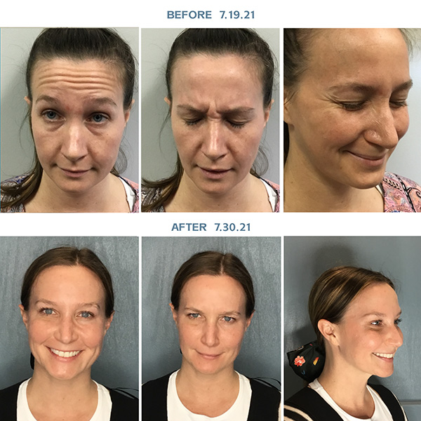 botox before and after