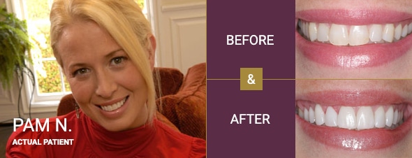 Smile Makeover Before & After, Beverly Hills and Los Angeles