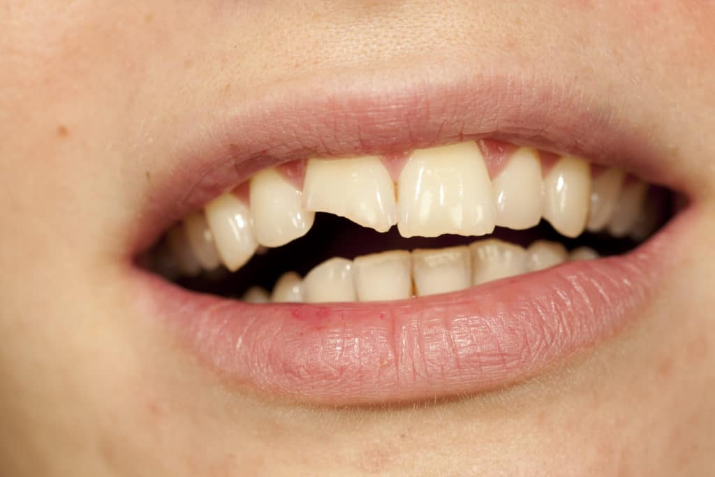 Chipped a Tooth? Dental Bonding is for You