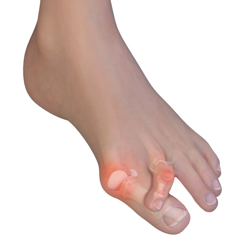 Learn More About Bunions What Are Bunions?