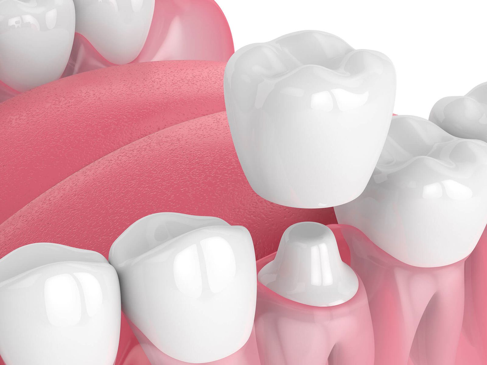 What Are the Pros and Cons of Dental Crowns?