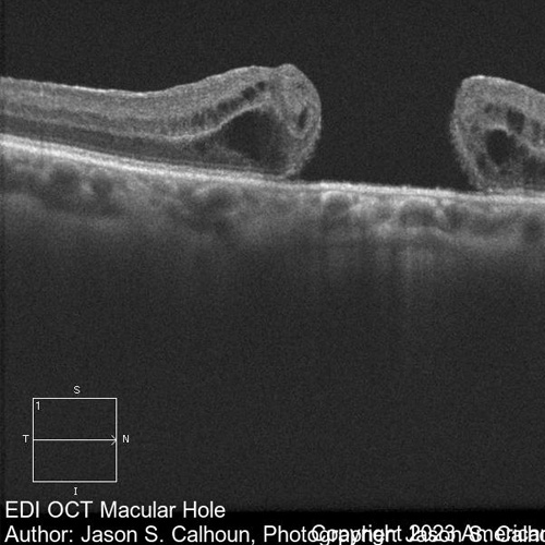 The Evolution of Macular Hole Surgery - Milestones In Retina