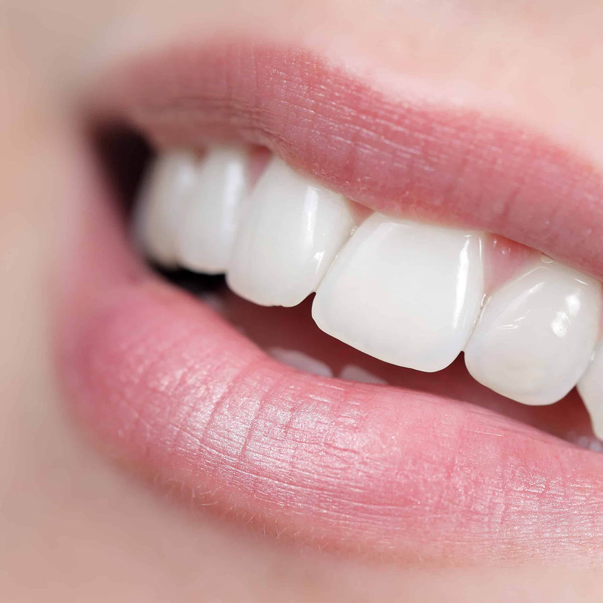 Composite Bonding Complete Dentistry Dentist Paisley Glasgow