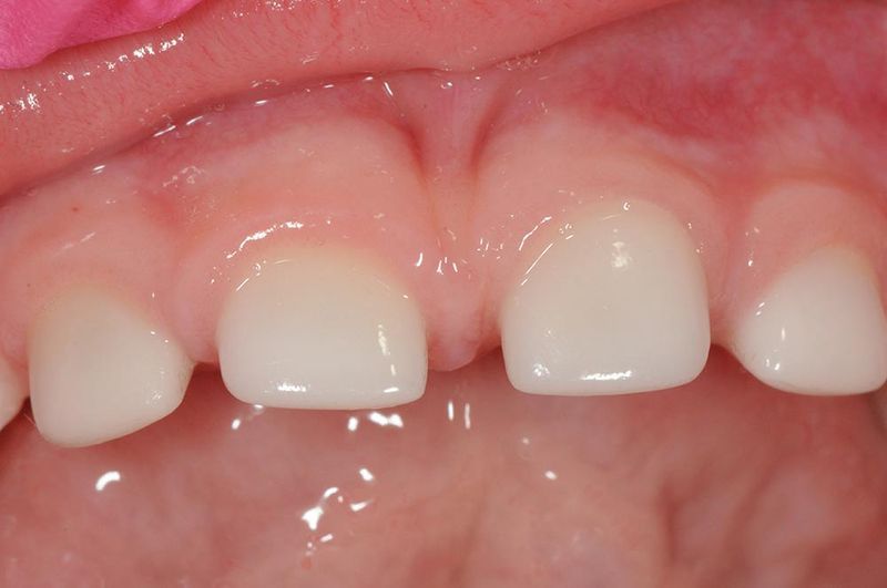 Zirconia Crowns for Children Kids in Narberth, PA