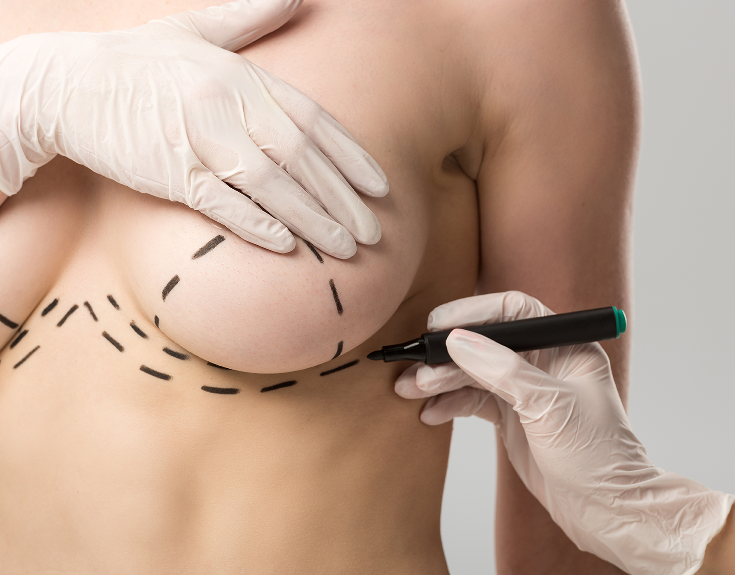 mamoplastia de reduccion
