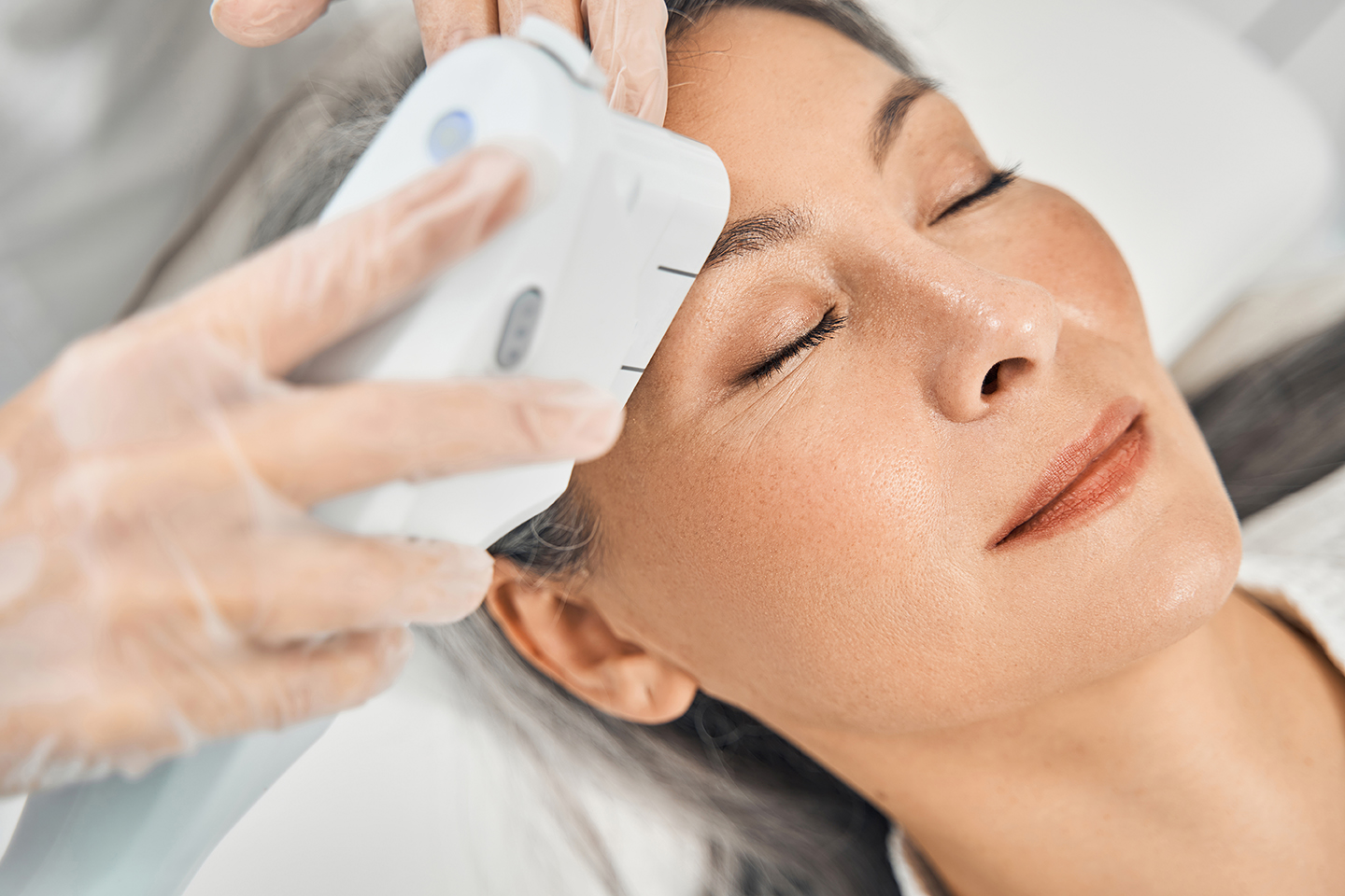 procedimiento laser aria medical