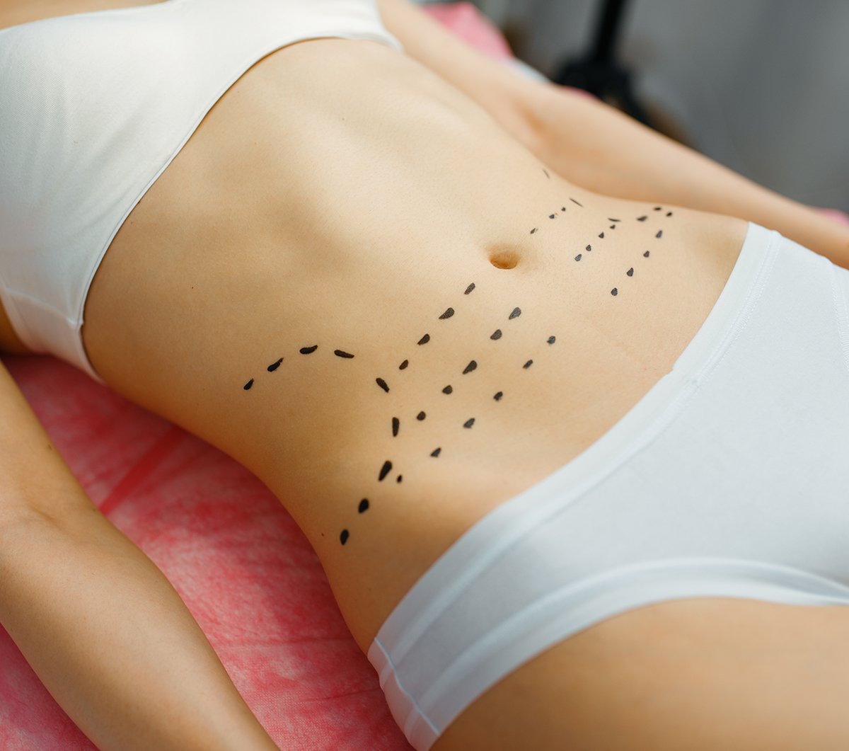 abdominoplastia aria medical